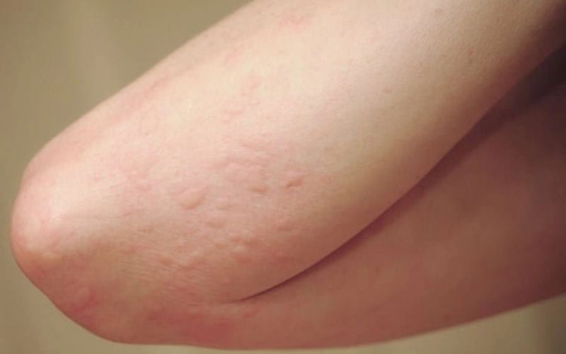 Người bị dị ứng với đậu nành