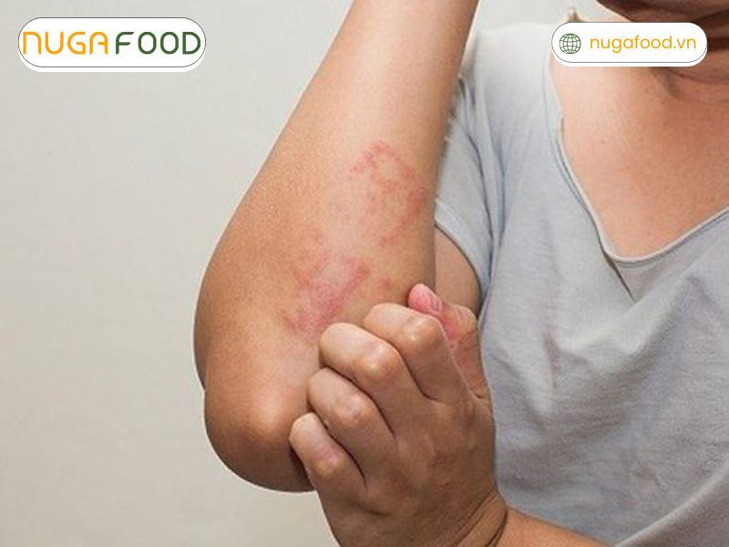 Người bị dị ứng với họ đậu không nên uống sữa đậu gà do nguy cơ kích ứng
